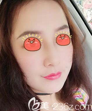 決定公開秀一下我找寧波美萊沈露芳做完全臉埋線提升后的效果及價格