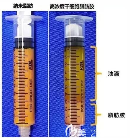蘇州紫馨擁有脂肪膠填充技術(shù)成活率高 蘇州紫馨擁有脂肪膠填充技術(shù)成活率高