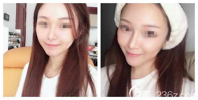 術(shù)后一周面部填充自體脂肪細胞膠效果 術(shù)后一周面部填充自體脂肪細胞膠效果