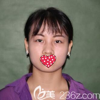 做達(dá)拉斯鼻綜合術(shù)前照 做達(dá)拉斯鼻綜合術(shù)前照