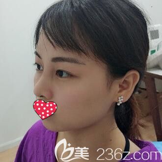 做鼻綜合術(shù)一周拆線效果 做鼻綜合術(shù)一周拆線效果