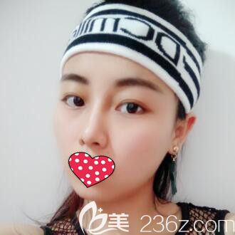 在長(zhǎng)沙希美做達(dá)拉斯鼻綜合術(shù)后18天效果 在長(zhǎng)沙希美做達(dá)拉斯鼻綜合術(shù)后18天效果