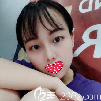 說下我找長沙希美蔣松林做達拉斯鼻綜合的親身經(jīng)歷及術(shù)后恢復效果圖片！