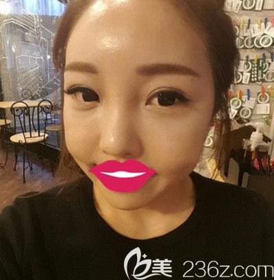 韓國自然主義眼睛+鼻子整形+全臉脂肪填充術(shù)后2周