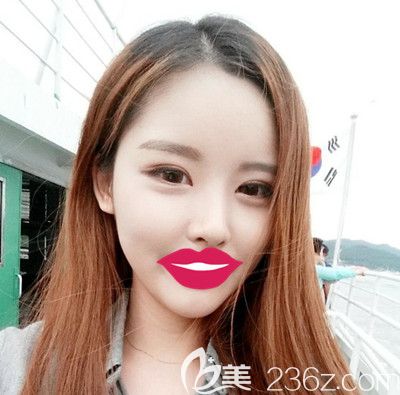 韓國自然主義眼睛+鼻子整形+全臉脂肪填充術(shù)后2個月