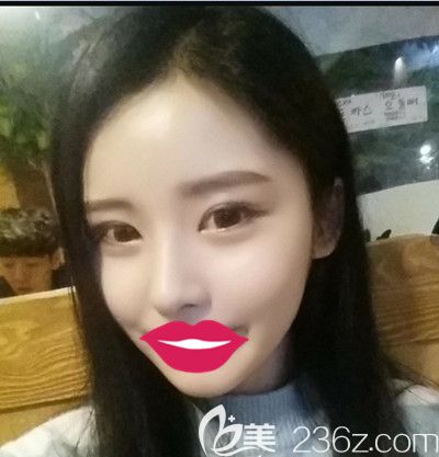 韓國自然主義眼睛+鼻子整形+全臉脂肪填充術(shù)后3個(gè)月后來分享下我恢復(fù)的過程