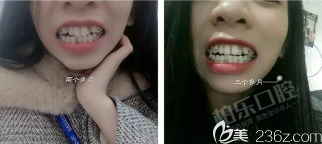 我在南寧柏樂口腔做半隱形牙齒矯正3個月效果