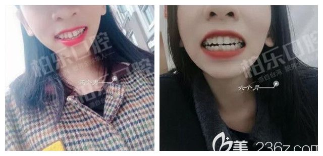 我在南寧柏樂口腔做半隱形陶瓷托槽牙齒矯正6個月