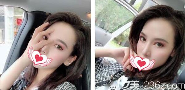 找陳茂年做綜合雙眼皮20天后,又做了玻尿酸填充淚溝,看效果是這樣的