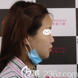 到<!--<i data=20240703-sp></i>-->做修復(fù)前假體下滑的鼻子 到<!--<i data=20240703-sp></i>-->做修復(fù)前假體下滑的鼻子