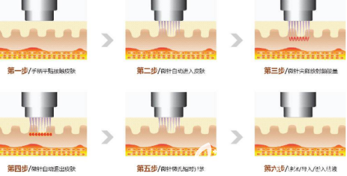黃金微針示意圖