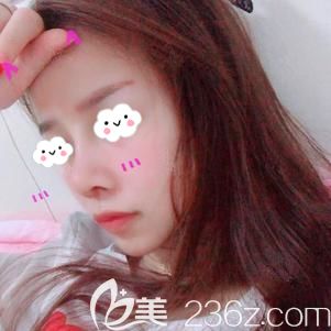 做鼻部修復(fù)術(shù)后7天拆線鼻小柱腫脹未消 做鼻部修復(fù)術(shù)后7天拆線鼻小柱腫脹未消