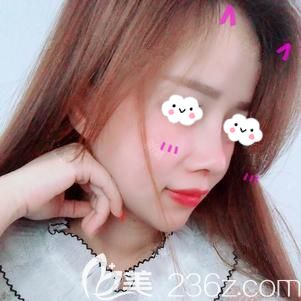 仇醫(yī)生做鼻部修復(fù)術(shù)后30天疤痕未消 仇醫(yī)生做鼻部修復(fù)術(shù)后30天疤痕未消