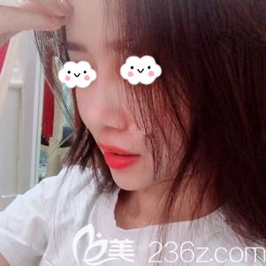 1年前做的隆鼻假體下滑現(xiàn)找到醫(yī)生做修復(fù)，術(shù)后鼻子自然挺拔且秀氣