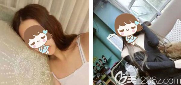 在<!--<i data=20240703-sp></i>-->整形割雙眼皮手術(shù)前 在<!--<i data=20240703-sp></i>-->整形割雙眼皮手術(shù)前