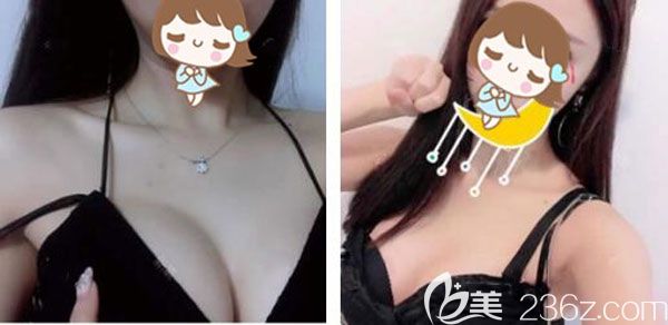 假體隆胸一個(gè)月摸著柔軟了很多 假體隆胸一個(gè)月摸著柔軟了很多