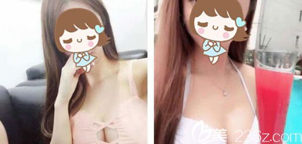 曼托假體隆胸60天沒有什么異物感 曼托假體隆胸60天沒有什么異物感