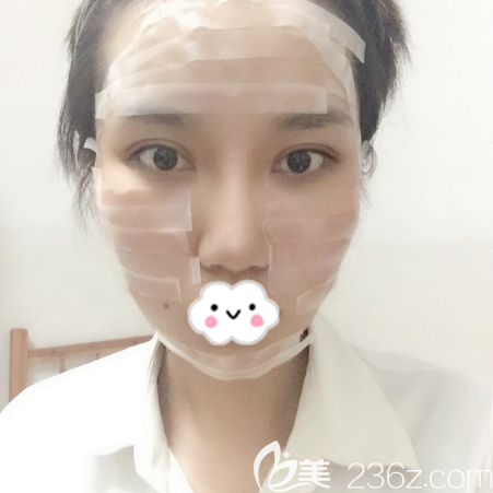 在廣州海峽做完脂肪填充術(shù)后第1天 在廣州海峽做完脂肪填充術(shù)后第1天