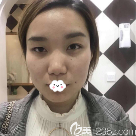 在廣州海峽做脂肪填充術(shù)前照片 在廣州海峽做脂肪填充術(shù)前照片