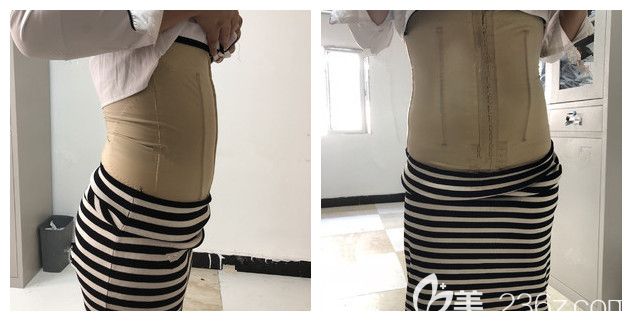 剛做完腰腹部吸脂術(shù)后穿著塑身衣
