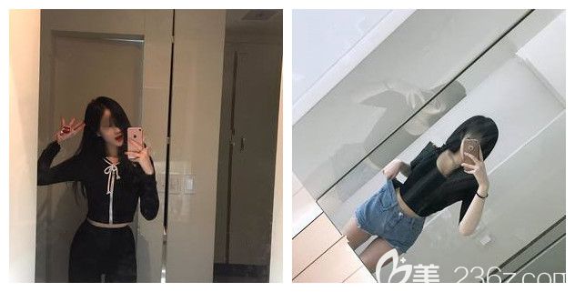 做腰腹部吸脂術(shù)后一個(gè)月恢復(fù)