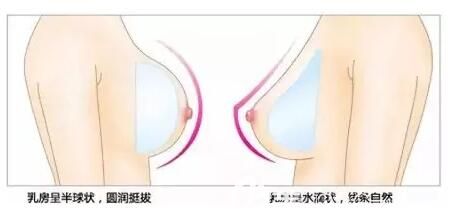假體豐胸后胸部形態(tài)