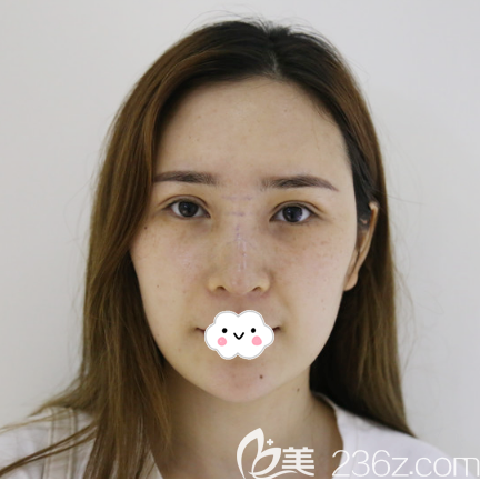 術(shù)前塌鼻子照片 術(shù)前塌鼻子照片