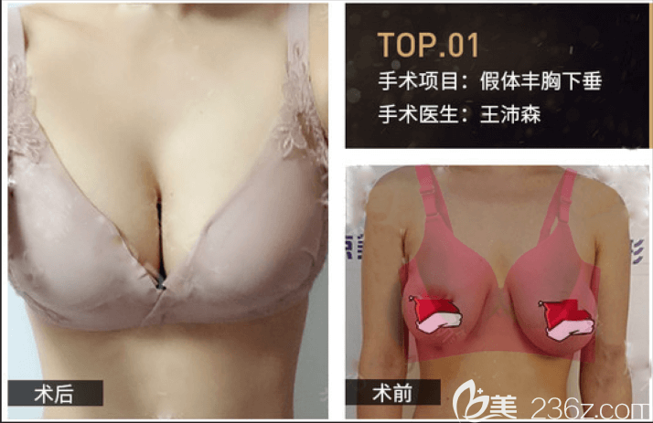 北京京韓王沛森假體豐胸下垂修復(fù)案例