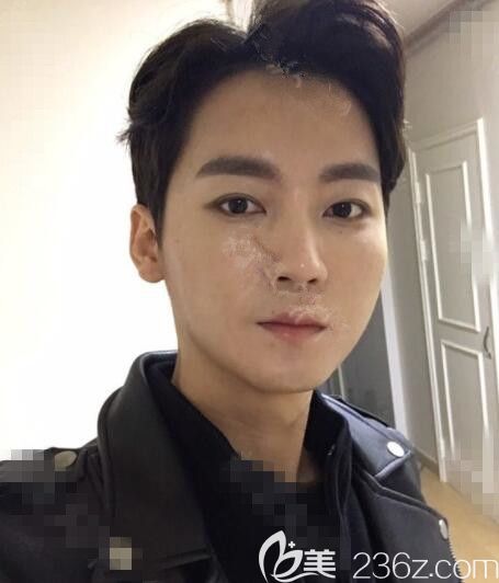 單眼皮好兇韓國芭堂額頭提升+埋線雙眼皮后感覺自己帥帥的噠