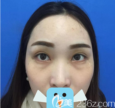 去眼袋術(shù)前素顏照片 去眼袋術(shù)前素顏照片