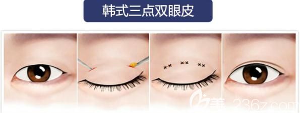 易韓定制韓式雙眼皮