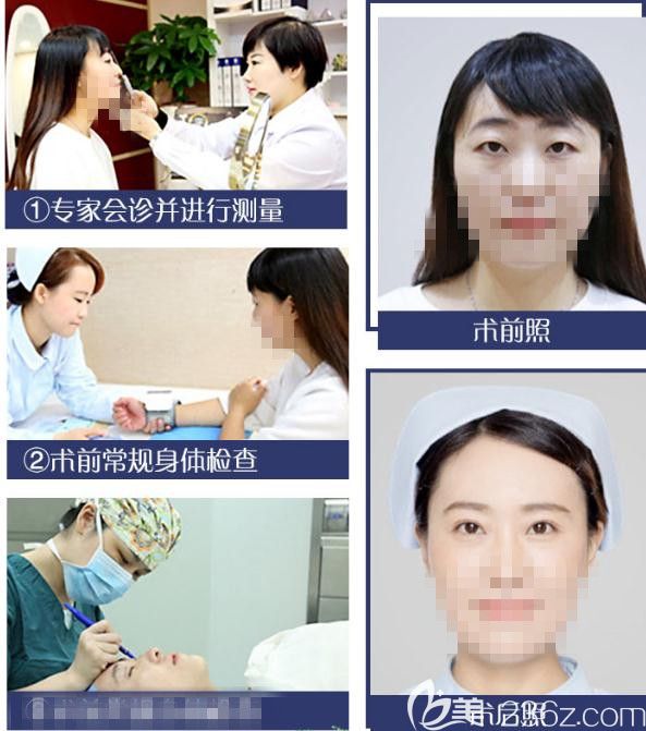 解密雙眼皮手術(shù)流程讓你做的放心