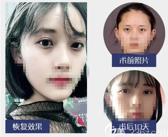 雙眼皮真人案例效果