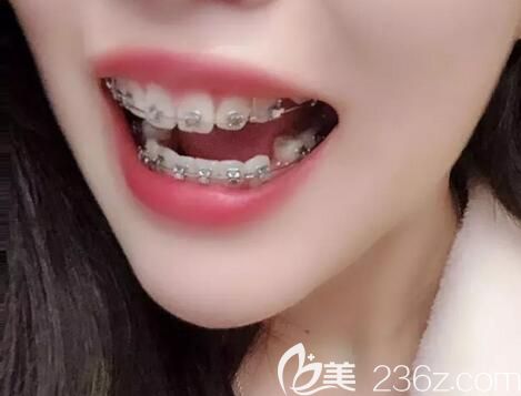 我在鄭州德正口腔做牙齒矯正第9個月 我在鄭州德正口腔做牙齒矯正第9個月