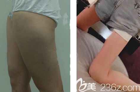 蘭州韓美陳誠(chéng)腿部吸脂案例 蘭州韓美陳誠(chéng)腿部吸脂案例