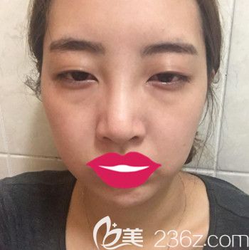 面診了幾個(gè)院長后選擇韓國朱諾的金信榮院長做了眼綜合+鼻綜合手術(shù)