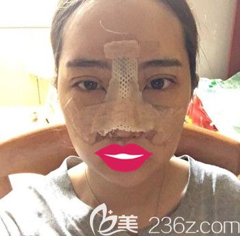 韓國朱諾做眼綜合+鼻綜合手術(shù)后3天