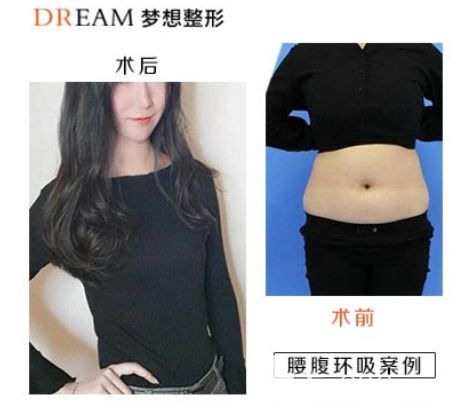 蘭州夢(mèng)想趙梅霞腰腹環(huán)吸效果案例 蘭州夢(mèng)想趙梅霞腰腹環(huán)吸效果案例