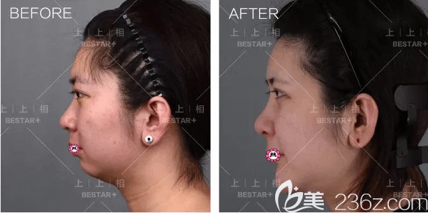 自體脂肪填充下巴哪家好？北京上上相自體脂肪填充下巴前后對(duì)比效果圖來(lái)參考