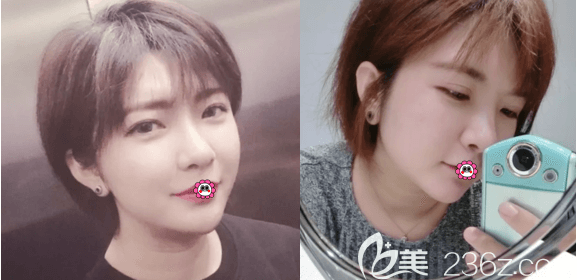 自體脂肪填充下巴哪家好?在北京上上相做自體脂肪填充下巴后我有了長且翹的下巴