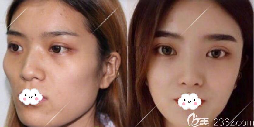 金一秀顴骨內(nèi)推+下頜角整形<span style=