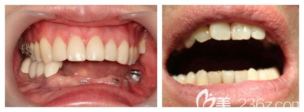 鄭州德正口腔種植牙案例