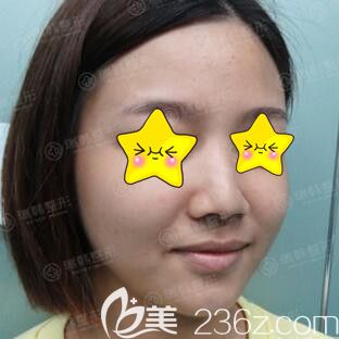 做蘿莉翹鼻術(shù)前照 做蘿莉翹鼻術(shù)前照