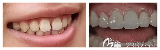 鄭州德正口腔牙齒矯正案例