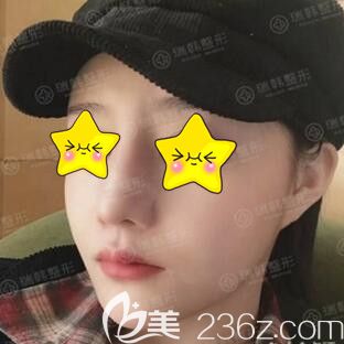 做鼻綜合整形術(shù)后第5天 做鼻綜合整形術(shù)后第5天