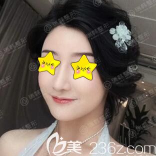 做完鼻綜合術(shù)后半個(gè)月效果圖 做完鼻綜合術(shù)后半個(gè)月效果圖