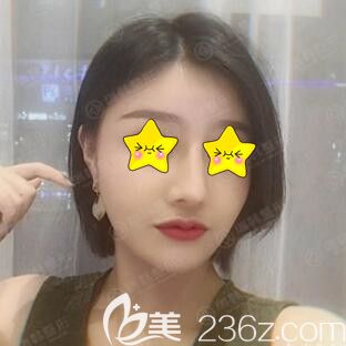 做鼻綜合術(shù)后21天效果圖 做鼻綜合術(shù)后21天效果圖