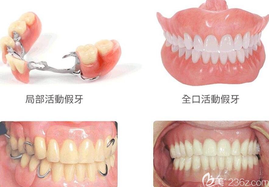 鄭州德正口腔孔德讓介紹活動(dòng)義齒優(yōu)勢(shì) 鄭州德正口腔孔德讓介紹活動(dòng)義齒優(yōu)勢(shì)