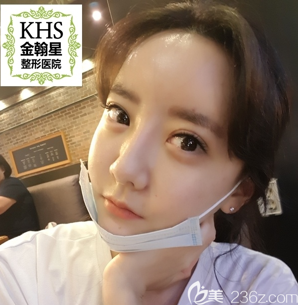韓國KHS金翰星整形prp0.02cc超細(xì)微脂肪移植1周后終于有了少女童顏臉