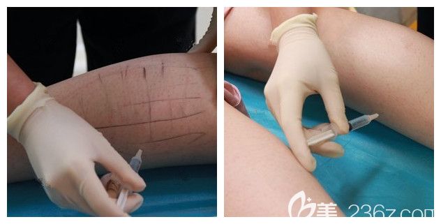 蘇州紫馨醫(yī)生注射瘦腿過程中 蘇州紫馨醫(yī)生注射瘦腿過程中